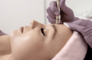 Microdermabrasion vancouver