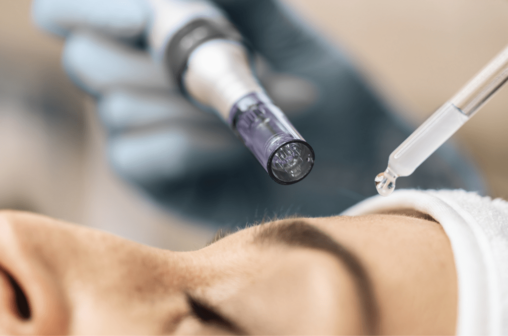 best microneedling vancouver