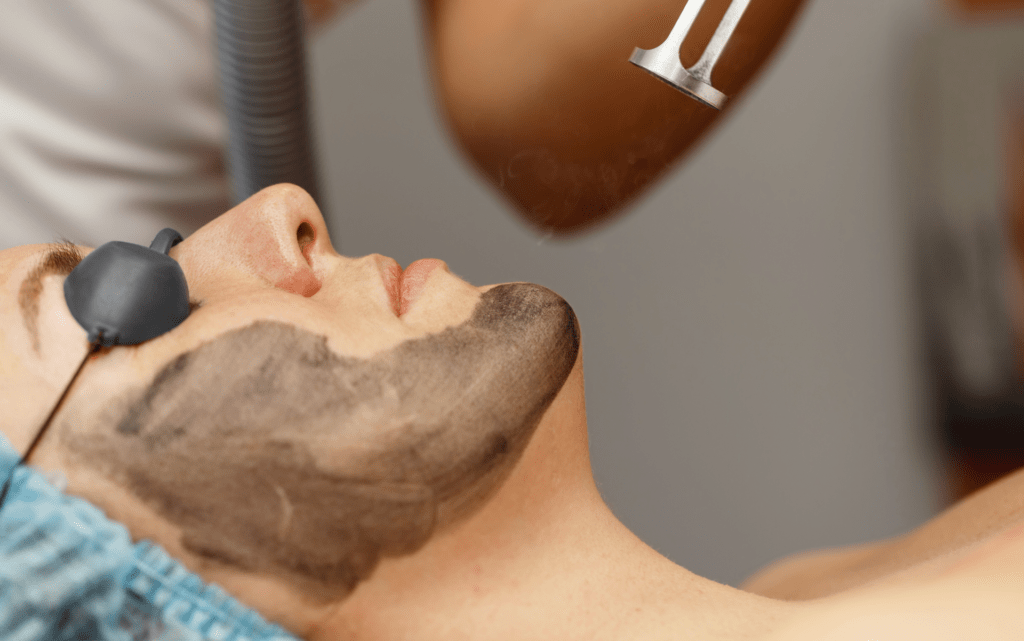 carbon laser facial