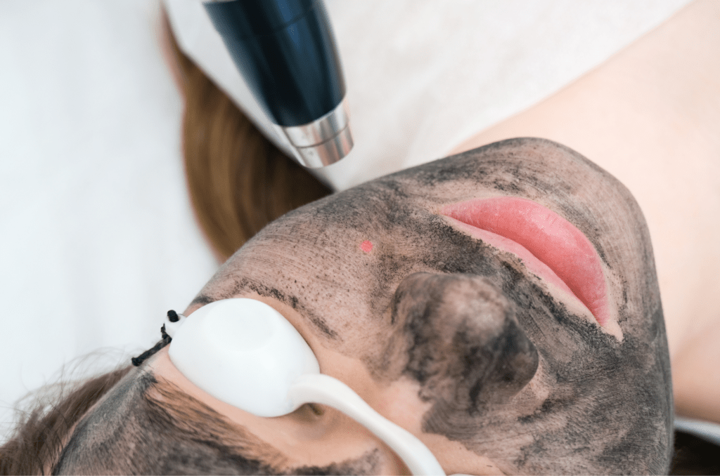 carbon laser peel