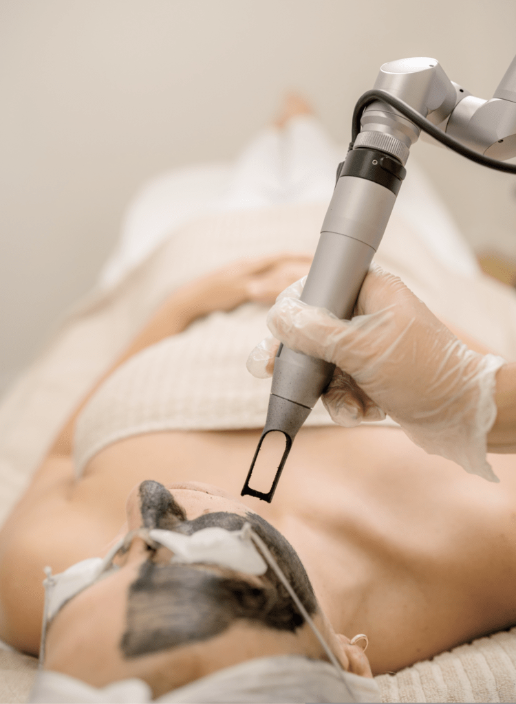 carbon peel in Vancouver
