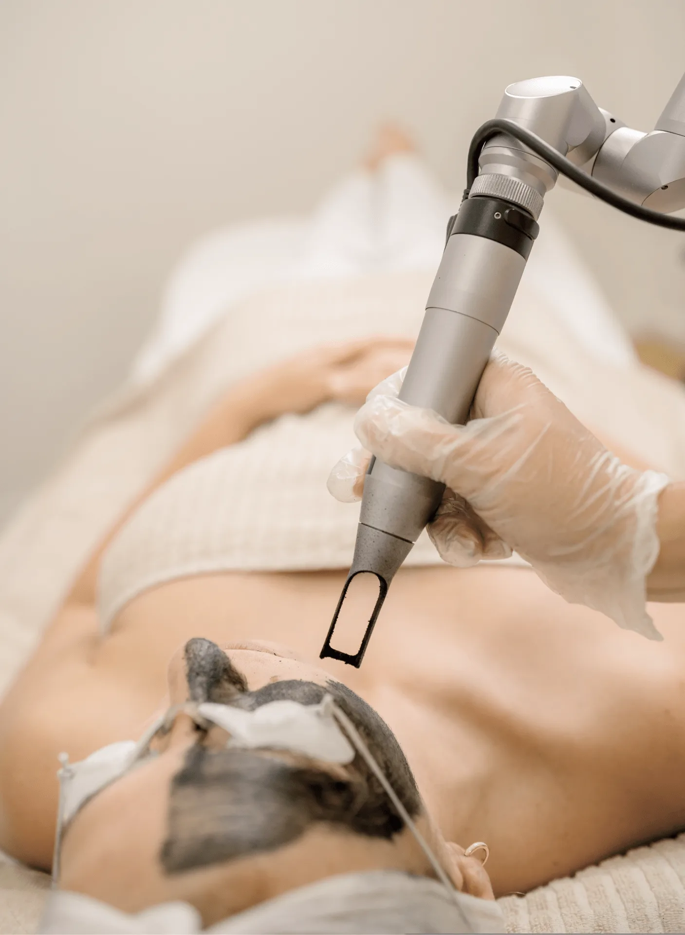 carbon peel in Vancouver