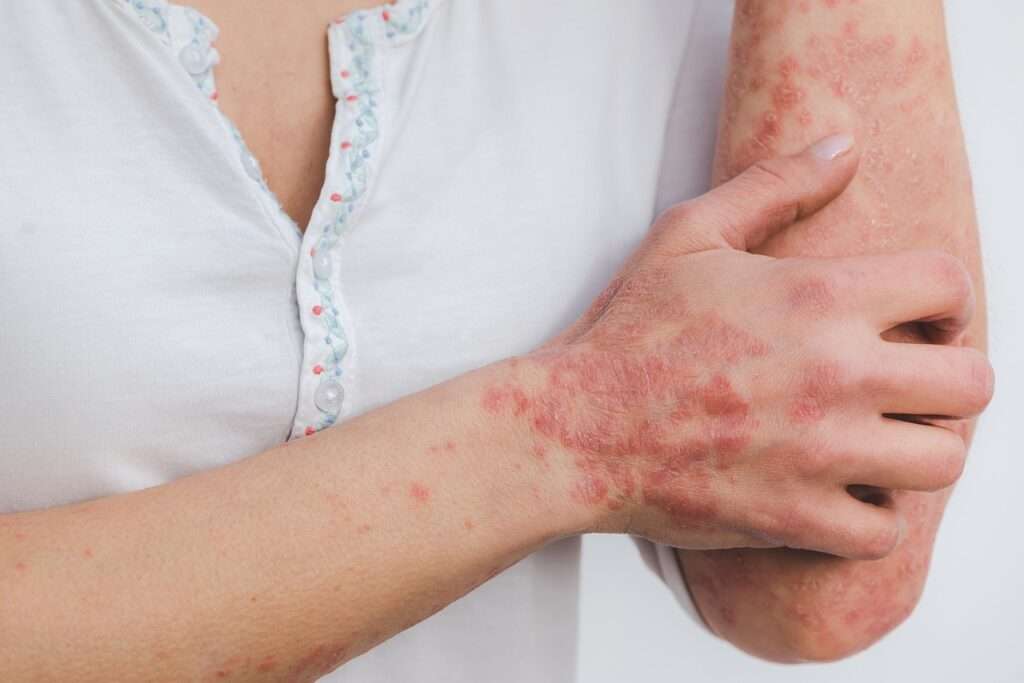 psoriasis, skin, disease