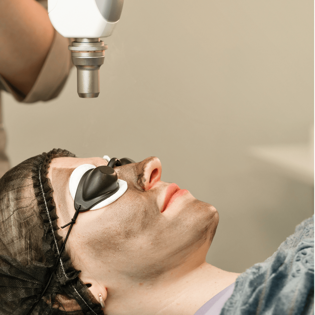 hollywood carbon laser peel