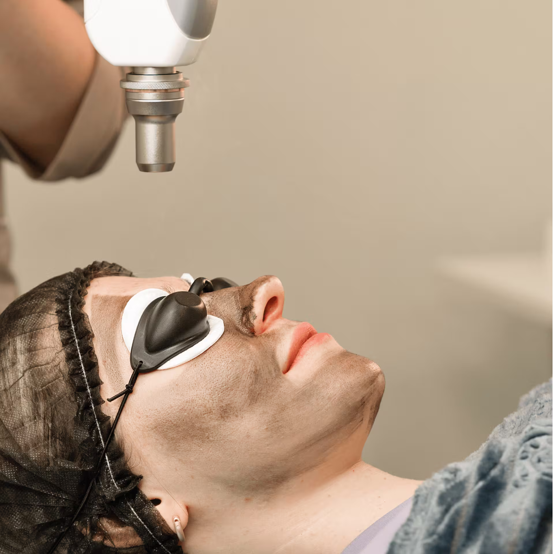 hollywood carbon laser peel in Vancouver Canada