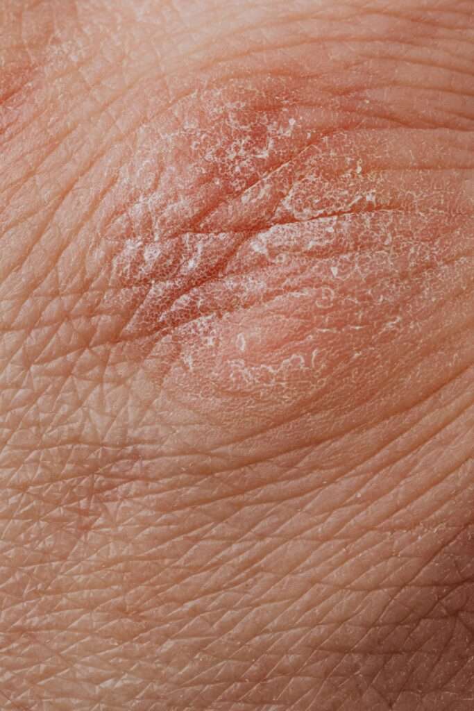 Close-up View Of Human Dry Skin