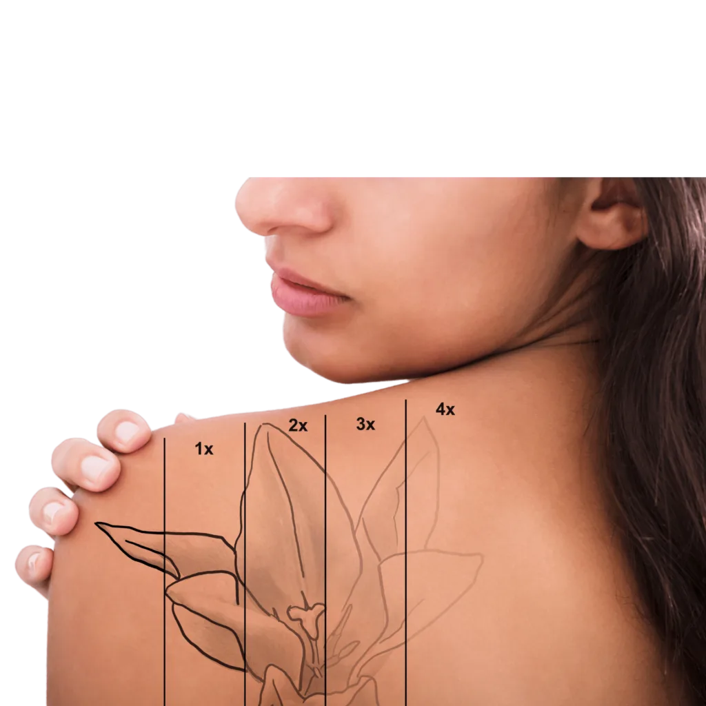 Laser tattoo removal in vancouver