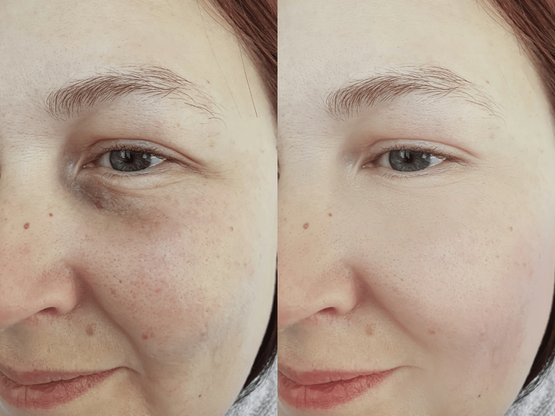 Chemical peel for Hyperpigmentation