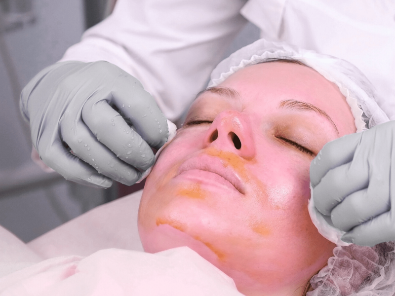 Chemical peel