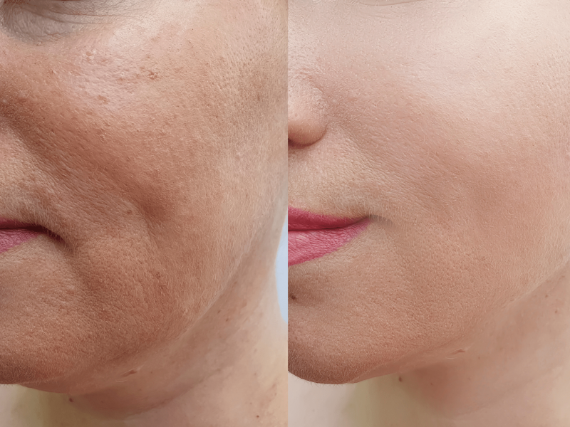 Chemical peel vancouver