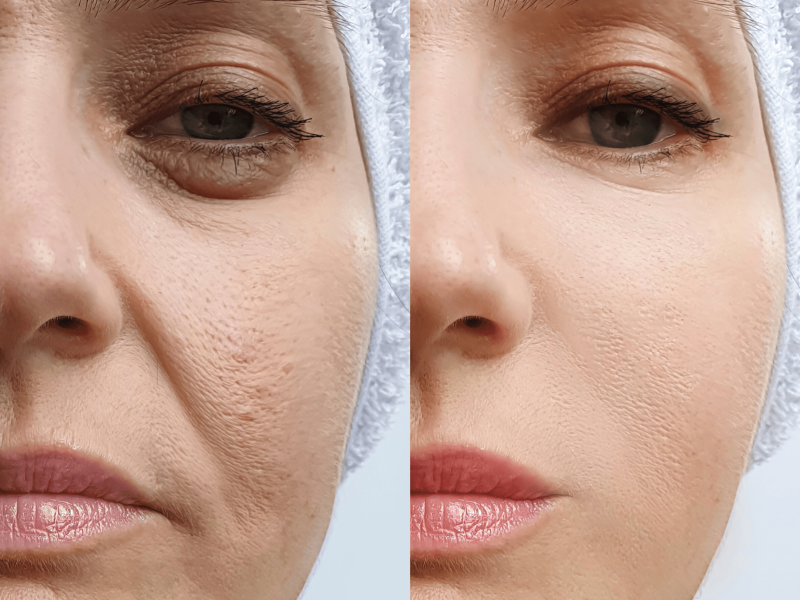 Chemical peel peeling for Fine lines and wrinkles