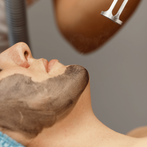 carbon laser facial